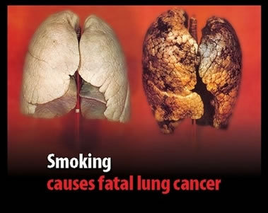 Human Lungs Smoker